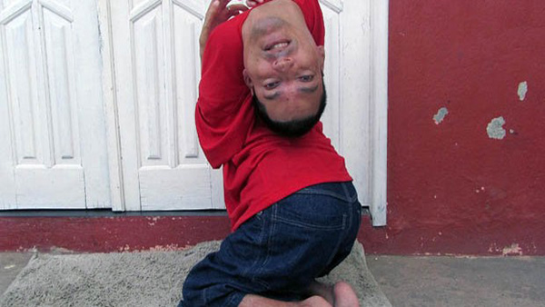 Il vit depuis 37 ans avec la tête à l’envers