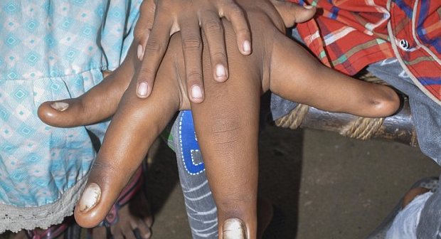 Insolite: Ce jeune indien possède les plus grosses mains du monde (photos)